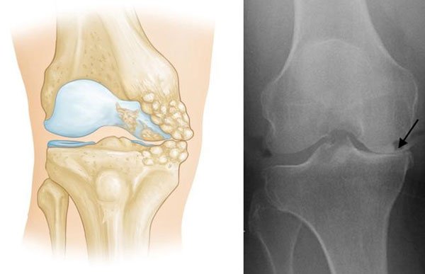 Unicompartmental Knee Replacement Sydney, NSW