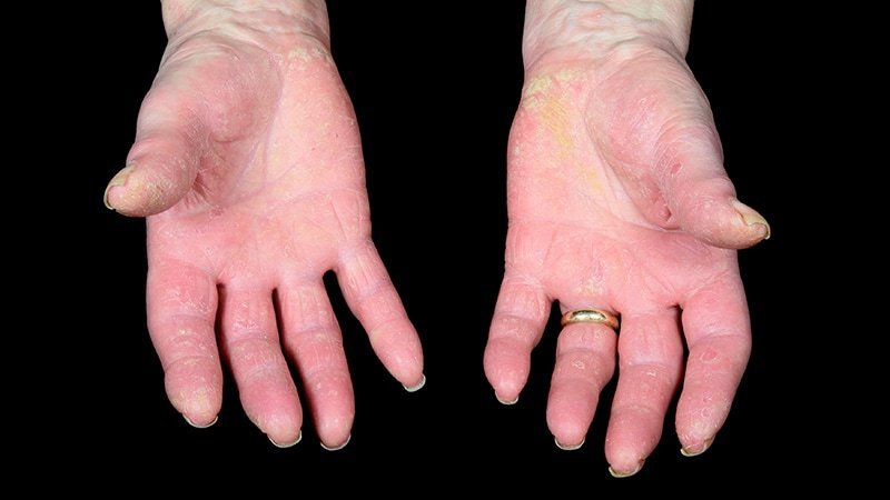 Upadacitinib Looks Effective for Psoriatic Arthritis