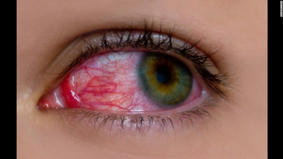 Uveitis, a rare eye disease, can blind people if not ...