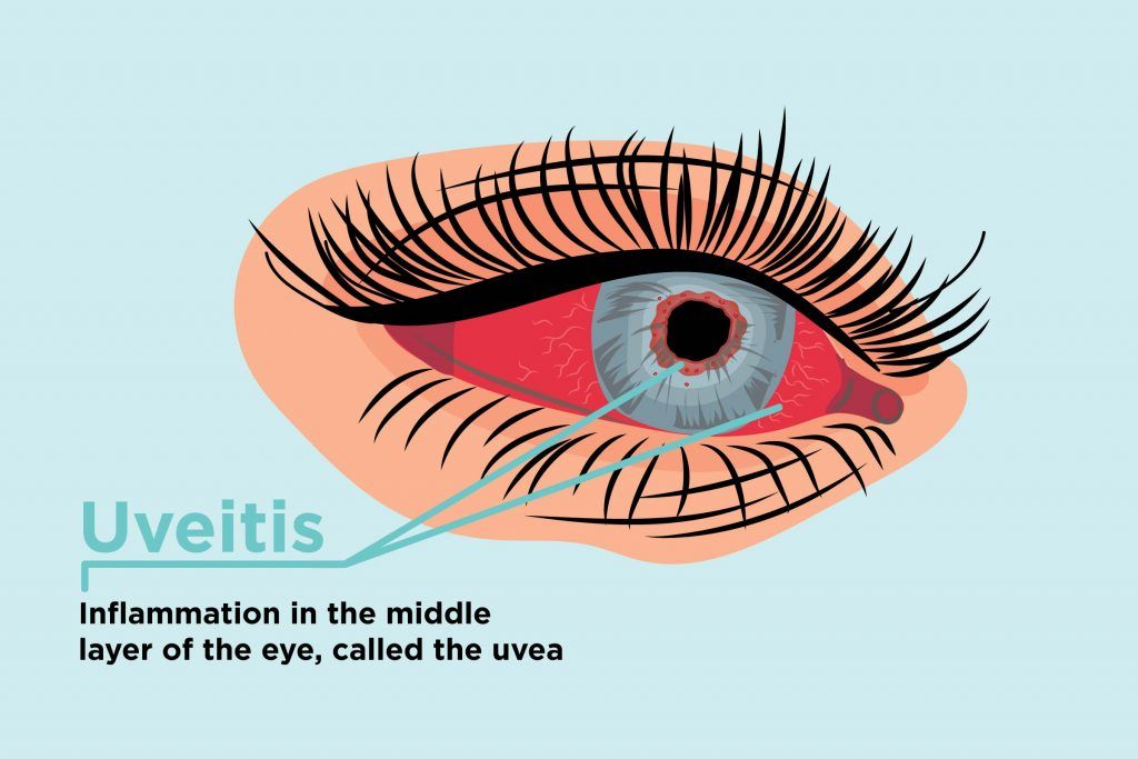 Uveitis and Arthritis: How Inflammation Can Affect Your ...
