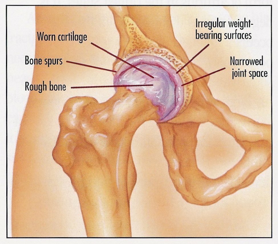 Various Options of Treatment for Hip Arthritis