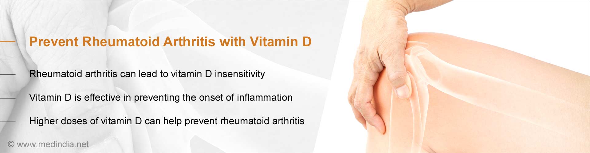 Vitamin D Helps Prevent Rheumatoid Arthritis