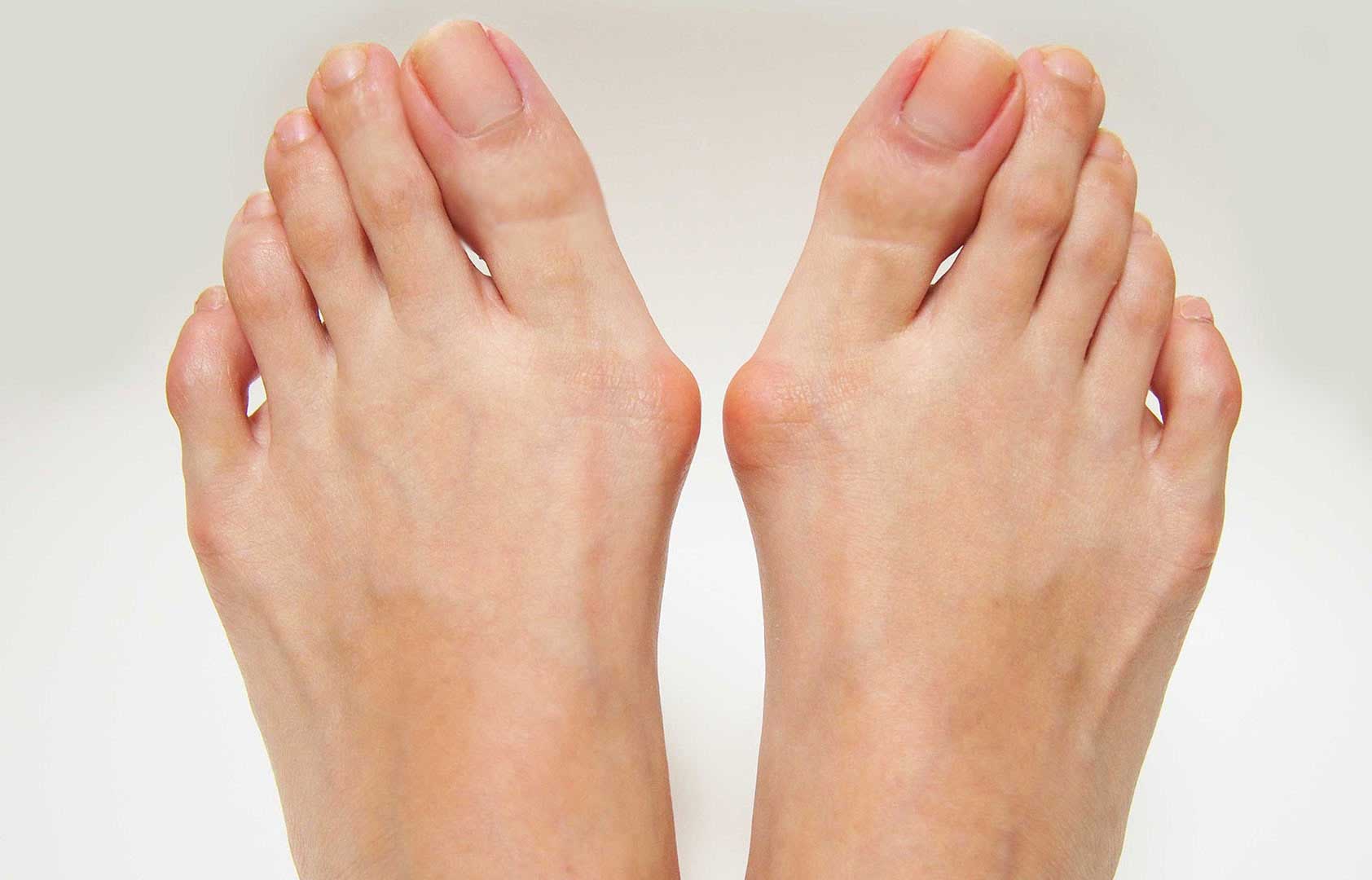 What are Bunions? What are its Symptoms, Causes and Treatment?
