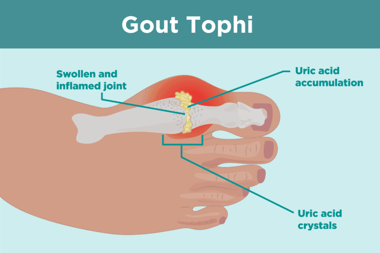 What Are Gout Tophi? Causes, Symptoms, and Treatments