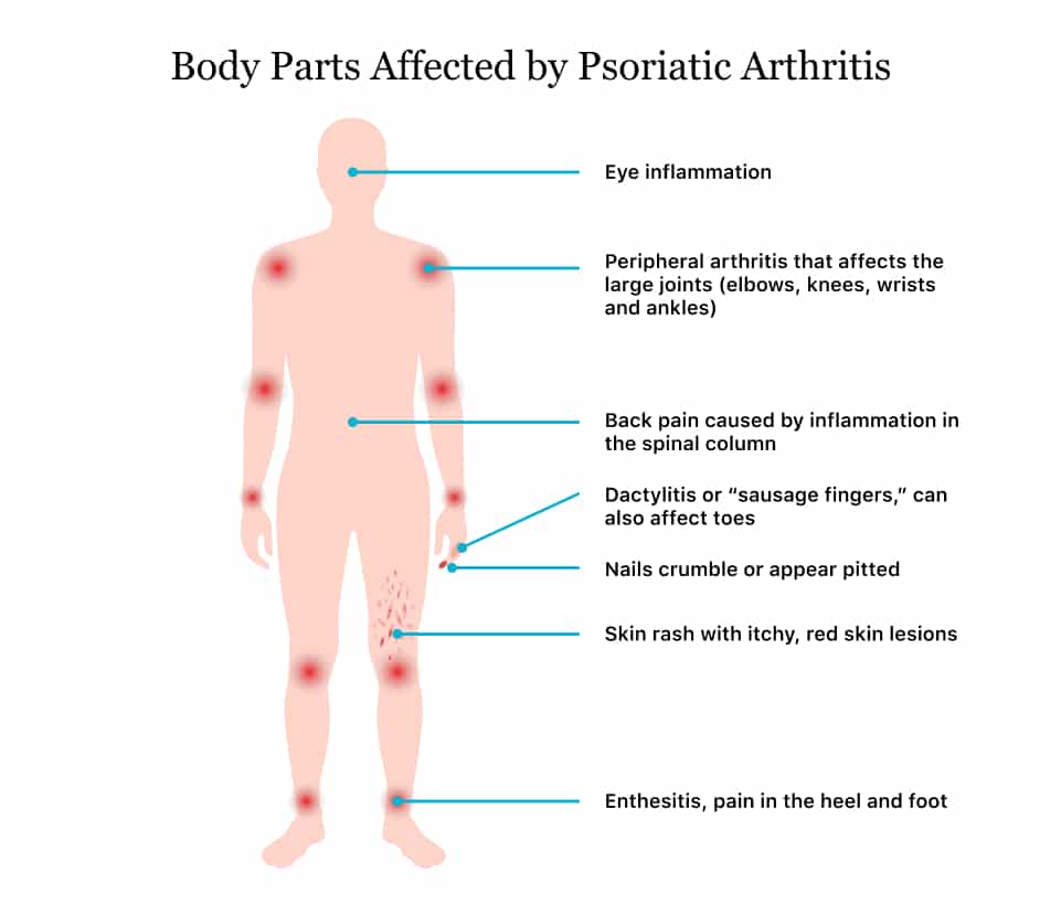What Are The Early Symptoms Of Psoriatic Arthritis