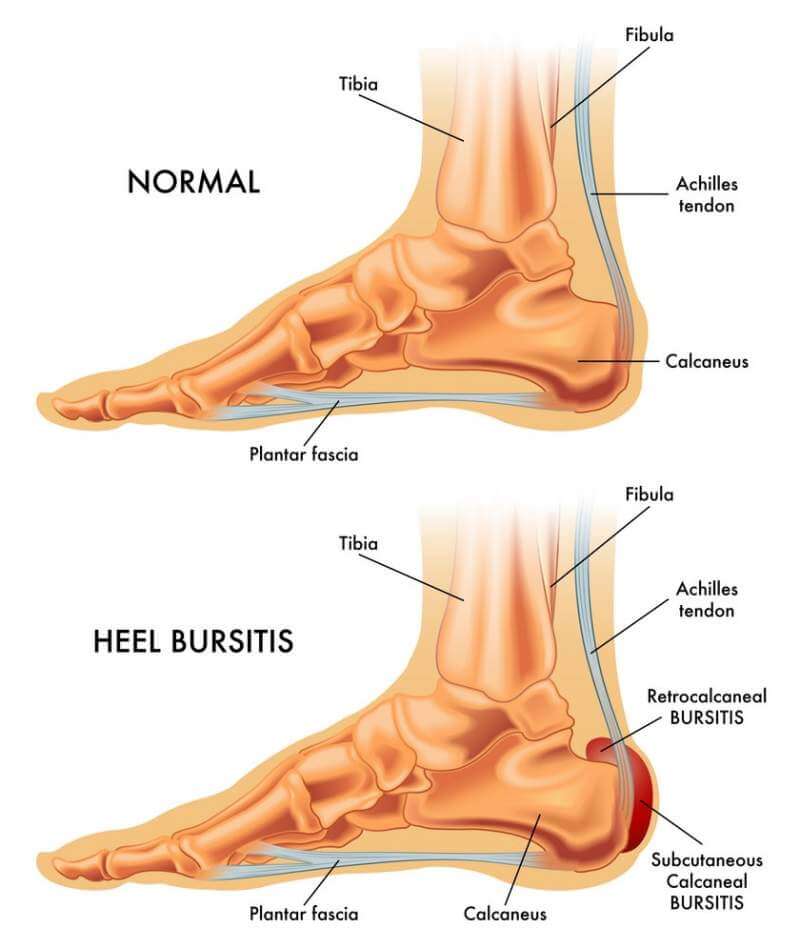 What Can Cause Ankle Pain When Walking? â Keep Healthy Living
