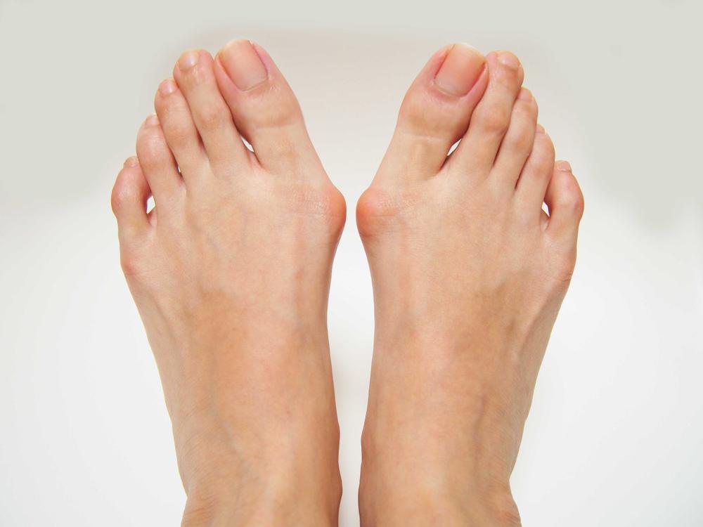 What Can I Do About My Bunions?: Kerry E. Berg, DPM: Foot Surgeon