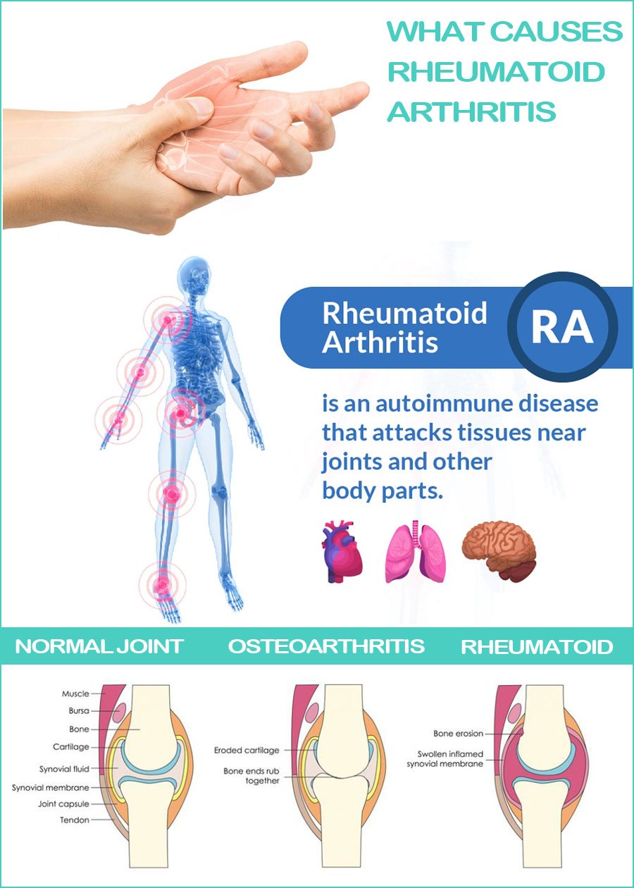What Causes Rheumatoid Arthritis? Symptoms and Treatment