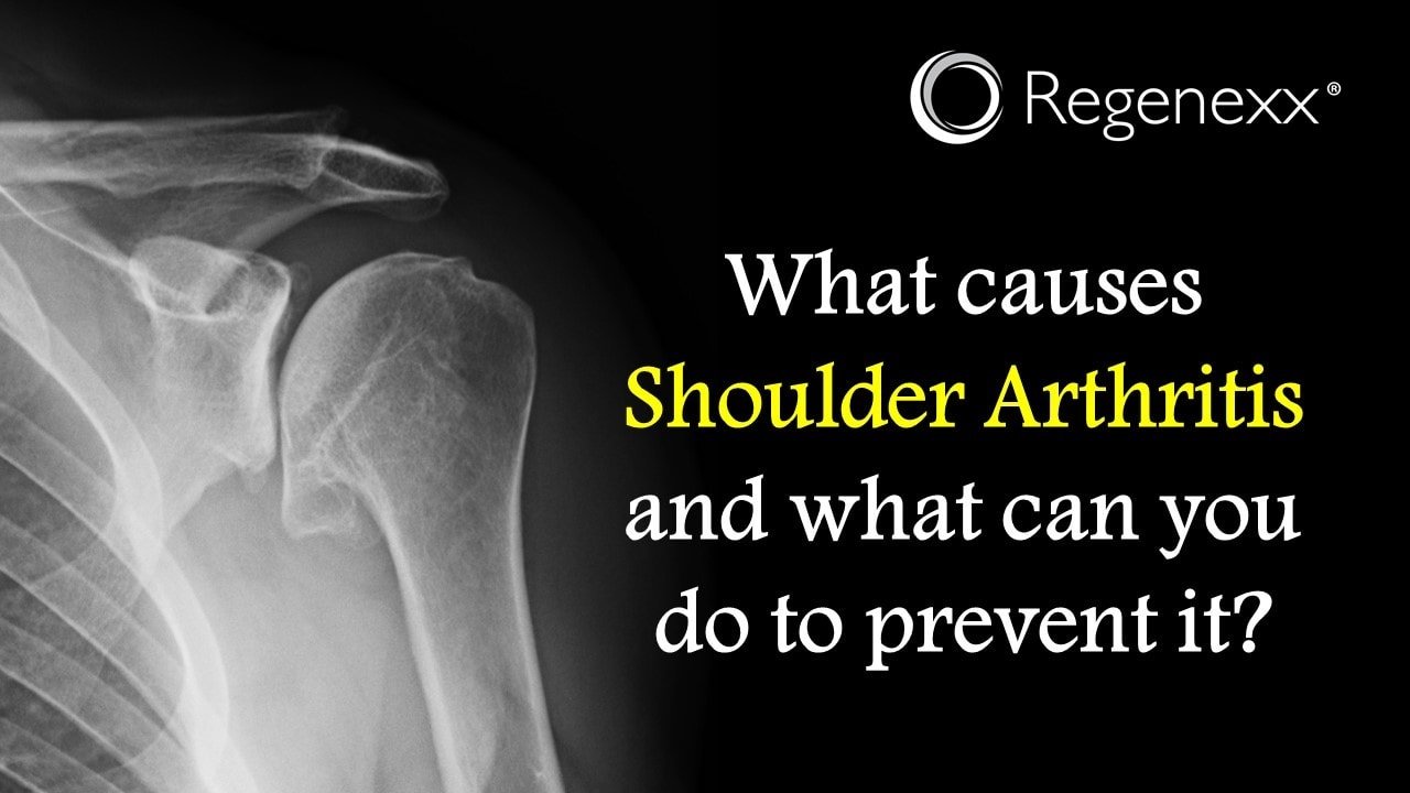 What Causes Shoulder Arthritis?