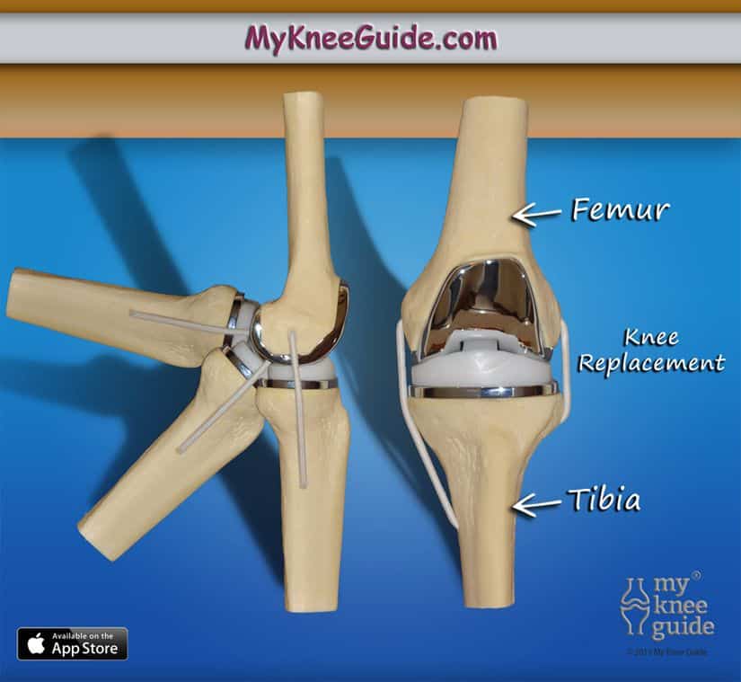 What does a total knee replacement look like? Take a look at these ...
