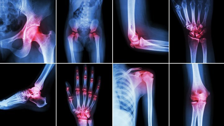 What Does Arthritis Pain Feel Like?