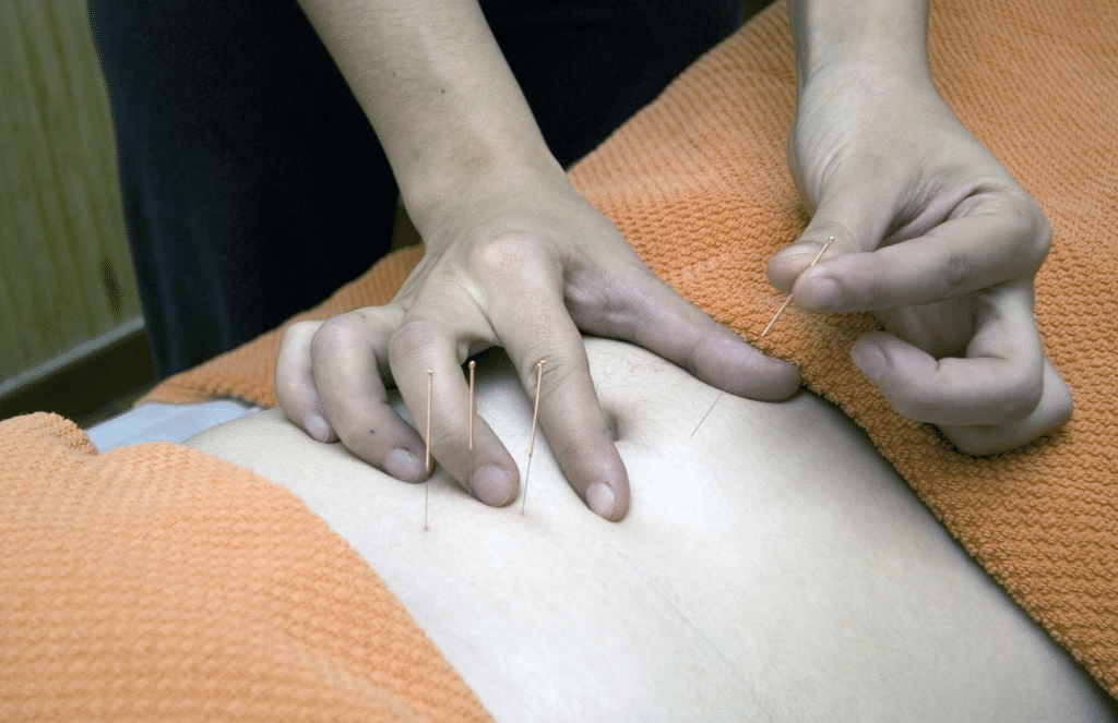 What Does Dry Needling Do and Can It Help With Pain? 2020