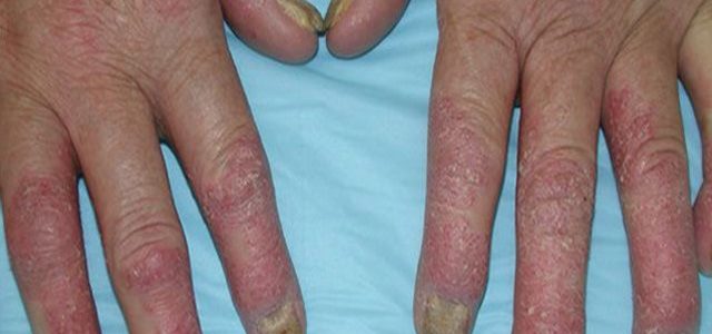 What Does Arthritis Rash Look Like