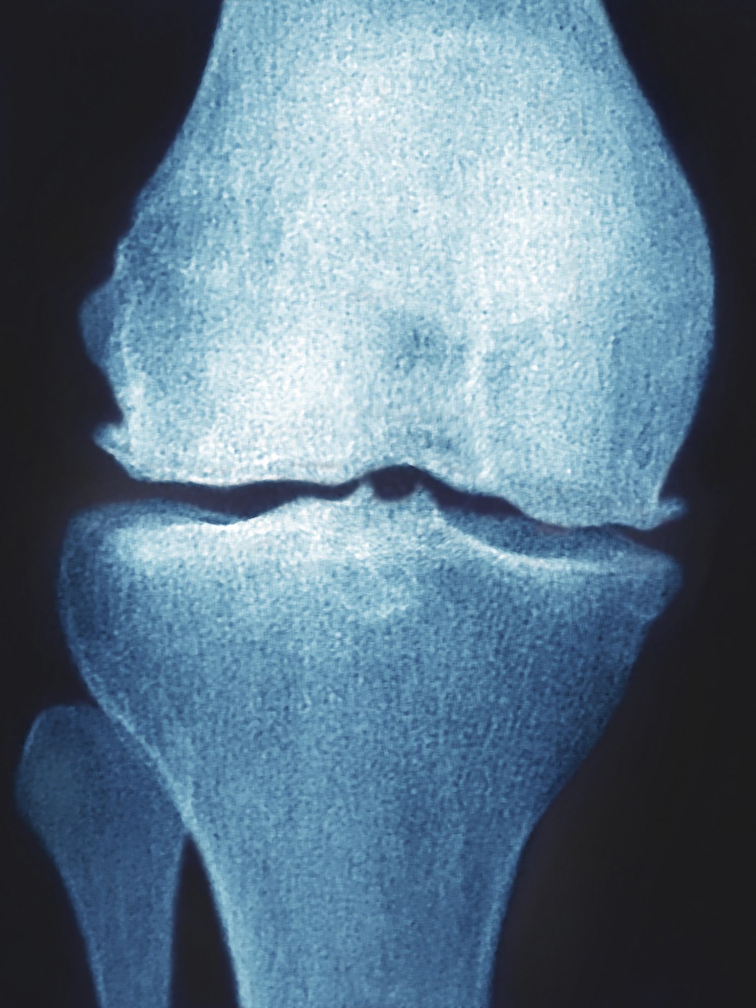What Is an Osteophyte (Bone Spur)?