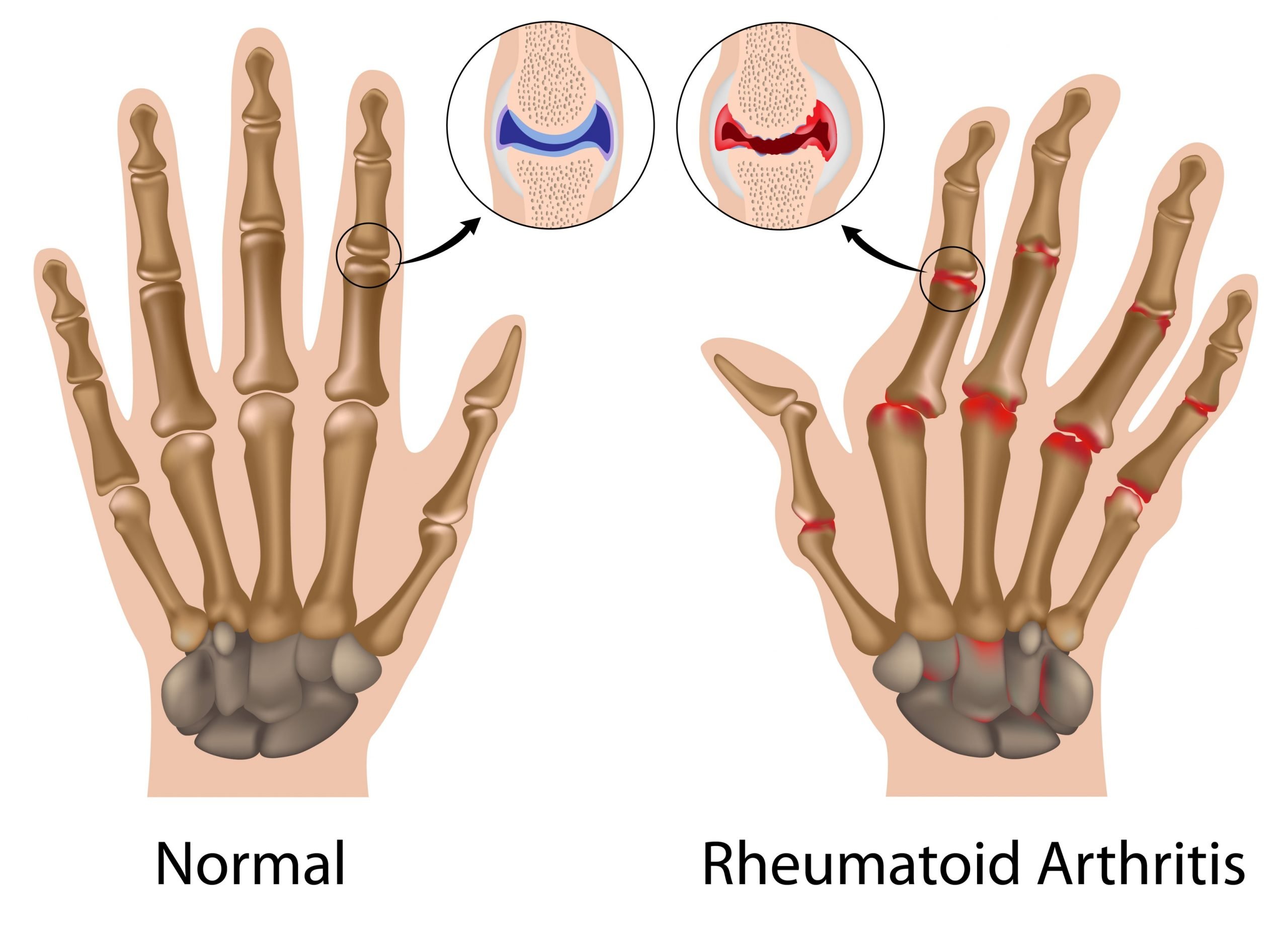 What Is Arthritis? It Could Be Gout, Rheumatoid Arthritis ...