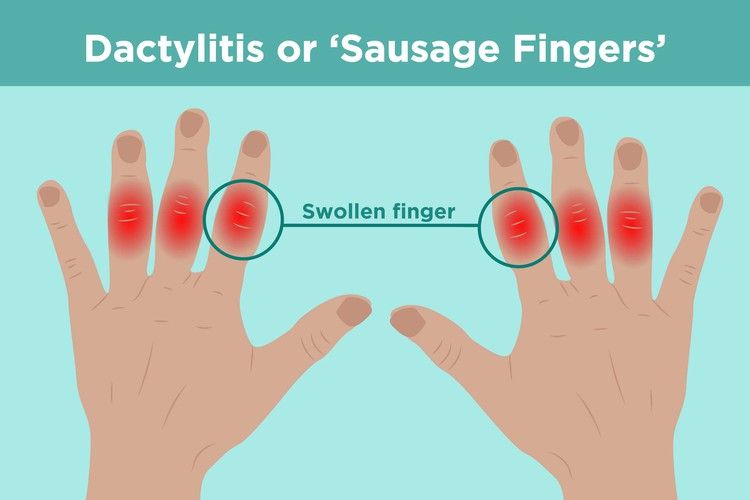 What Is Dactylitis? The Sausage Finger Swelling You Should Know About ...