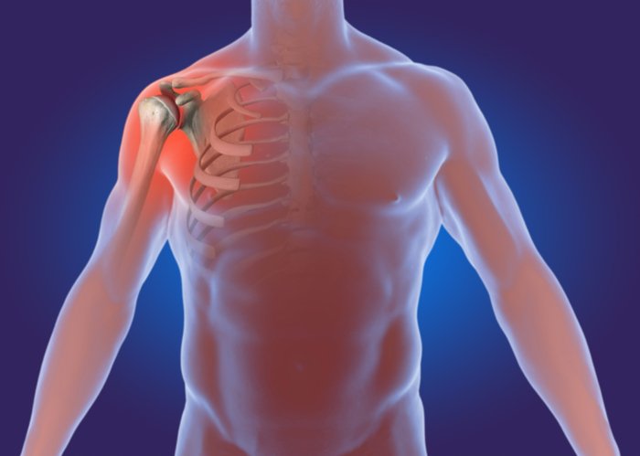What is Degenerative Arthritis of the Shoulder?