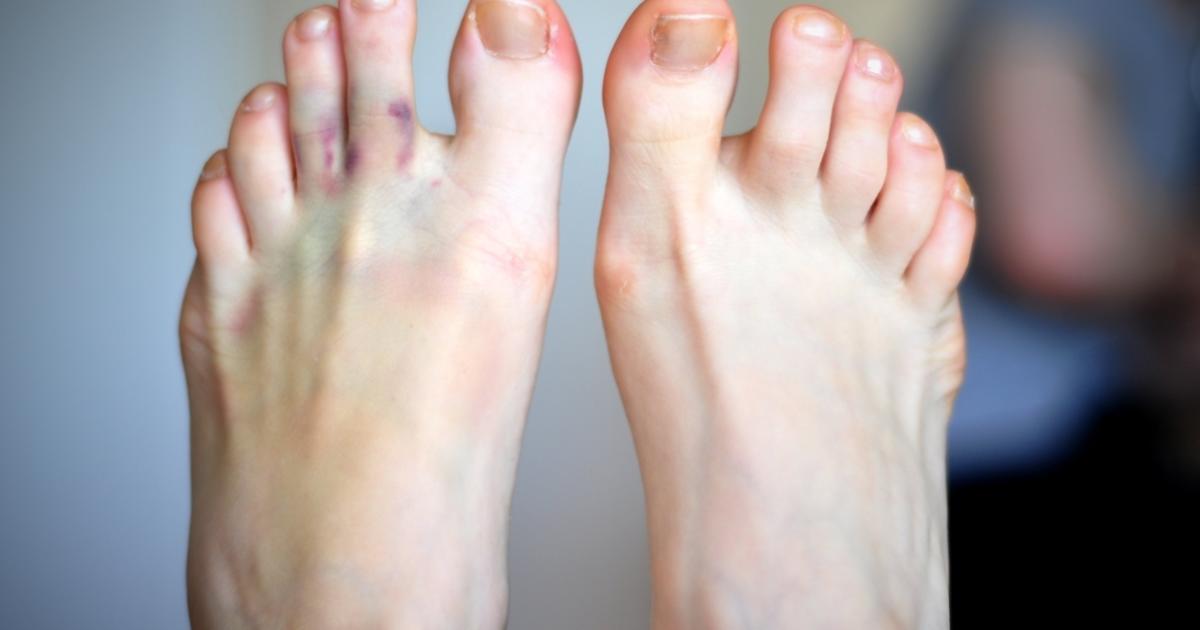 What is Gout? Causes and Who is at Risk of getting Gout?