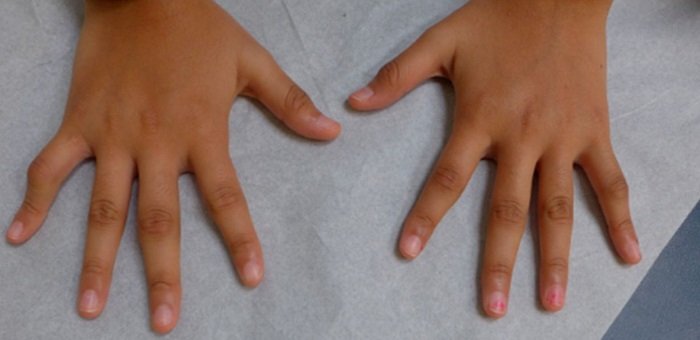 What is Juvenile Idiopathic Arthritis: Causes, Symptoms ...