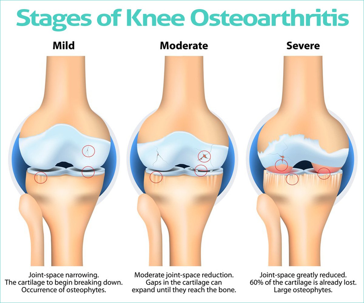What Is Osteoarthritis: Stages of Knee Osteoarthritis