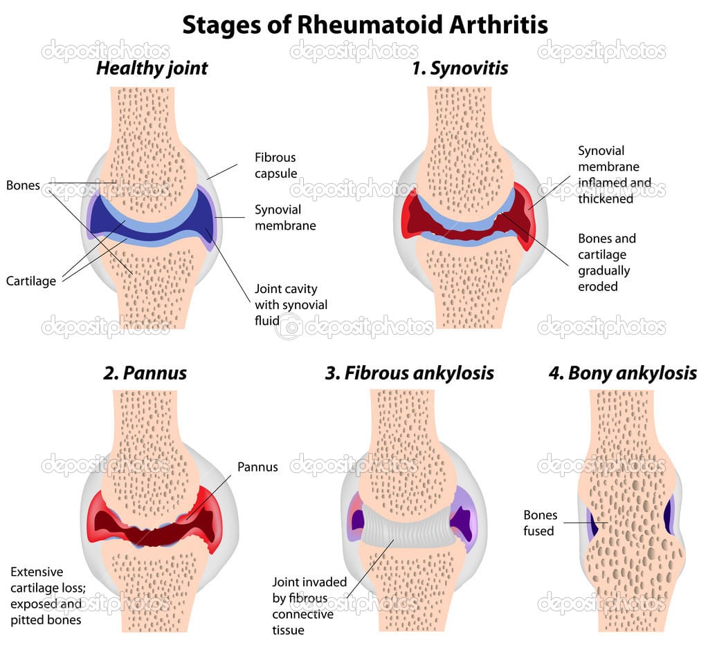 What Is Rheumatoid Arthritis? ~ EYDASUKIMAN