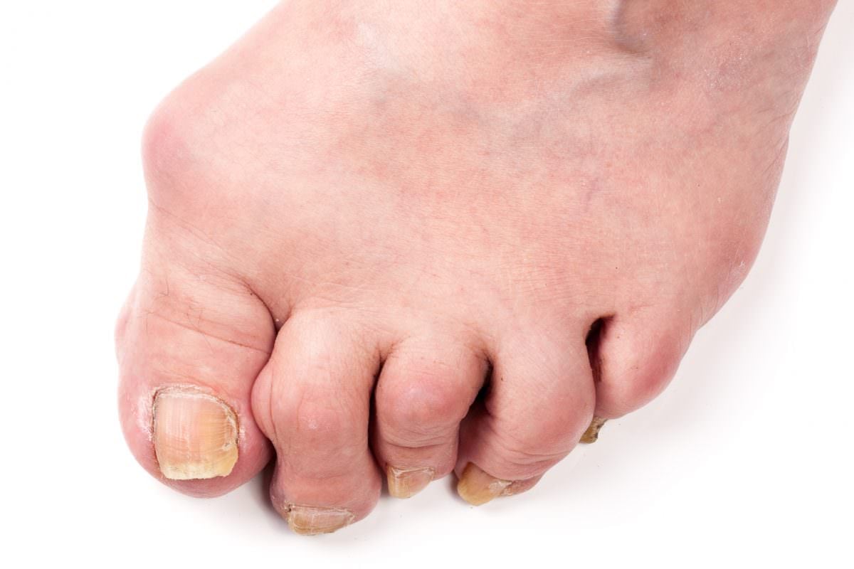 What is Rheumatoid Arthritis in The Foot