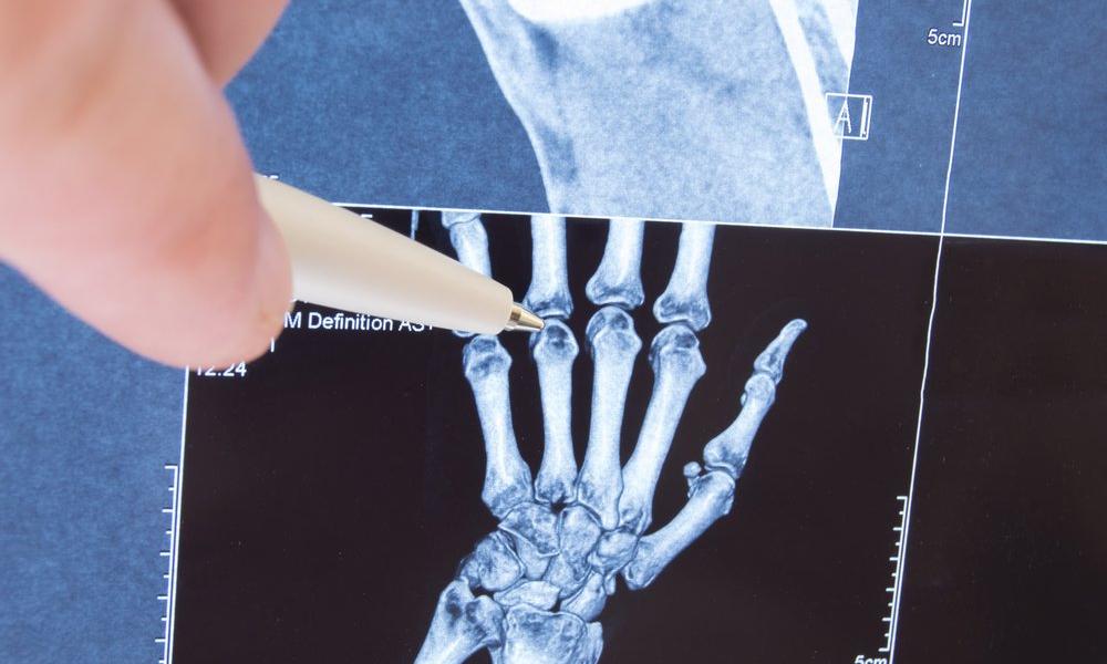 What is rheumatoid arthritis (RA)?
