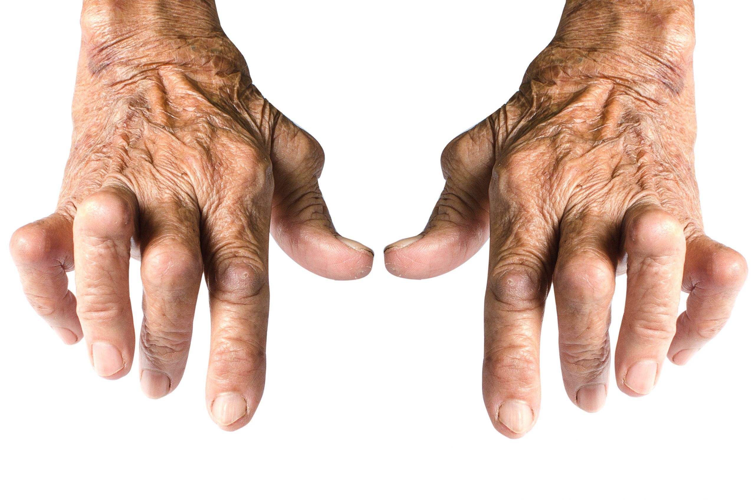 What is Seropositive Rheumatoid Arthritis?