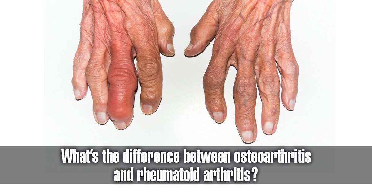 What is the Difference Between Osteoarthritis and ...