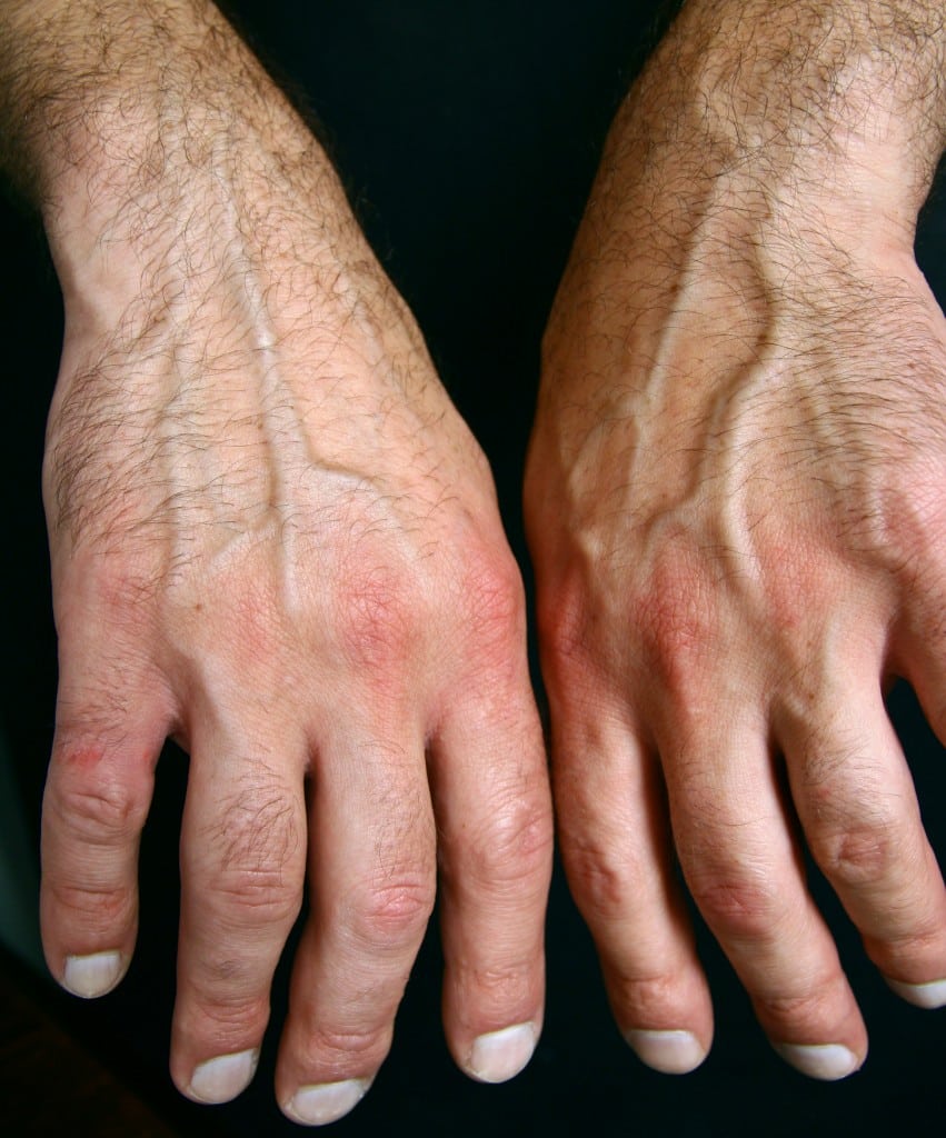 What People Should Know When It Comes To Arthritis
