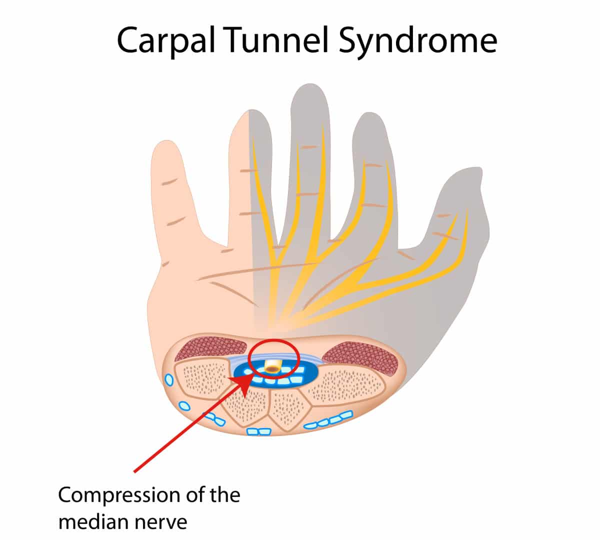 What to Expect After Carpal Tunnel Surgery: A Personal Experience ...