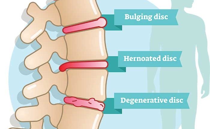 What To Look For In A Mattress With Degenerative Disc Disease