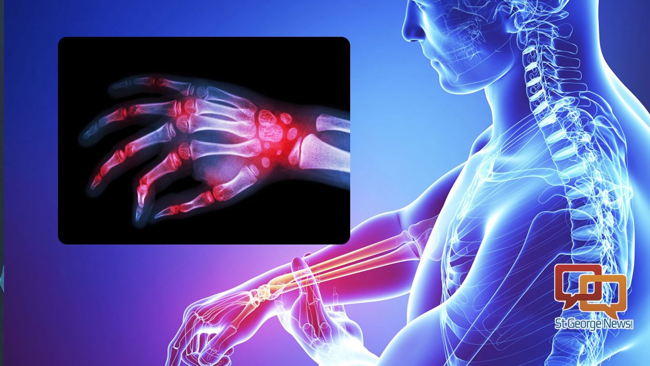 What you need to know about rheumatoid arthritis â St George News