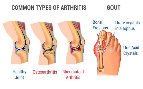 Who Does Arthritis Affect?