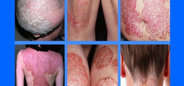 Why Do I Have Psoriasis