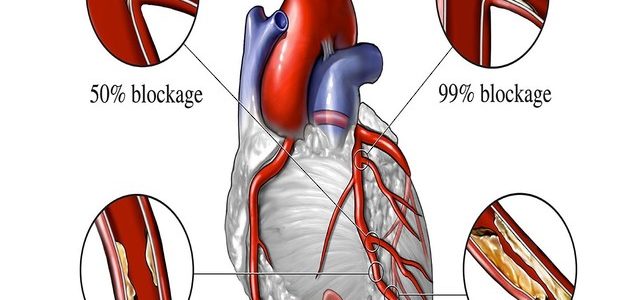 Why Does Rheumatoid Arthritis Affect The Heart