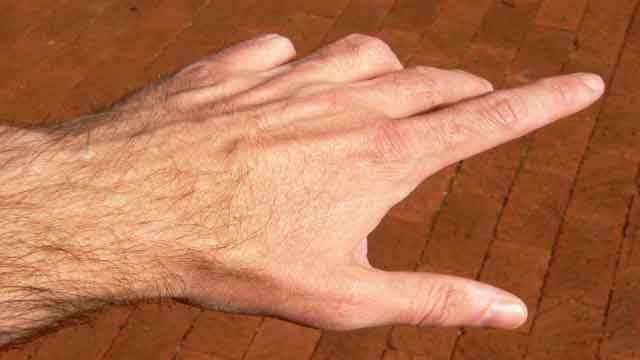 Will Popping or Cracking Your Knuckles Lead to Arthritis
