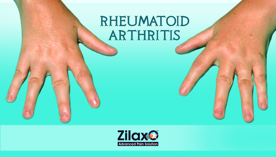 Zilaxo Advanced Pain Solution: Rheumatoid Arthritis